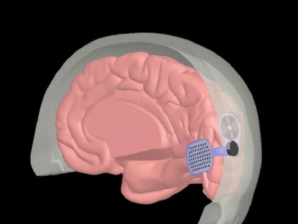 ದೃಷ್ಟಿಹೀನರಿಗೆ ಮರುದೃಷ್ಟಿಯ ವರದಾನ ಬಯೋನಿಕ್ ಐ