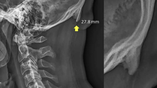 ಮೊಬೈಲ್ ಬಳಕೆಯಿಂದ ತಲೆಮೇಲೆ ಬೆಳೆಯುತ್ತಿದೆ ಕೊಂಬು!!